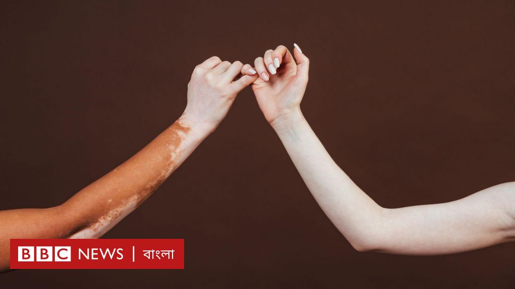 শ্বেতী রোগ কি ছোঁয়াচে, এটি কি নিরাময়যোগ্য অসুখ?